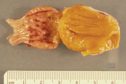 Influenza Aviar: Pollo, proventrículo. Hay múltiples hemorragias en la superficie mucosa del proventrículo. 