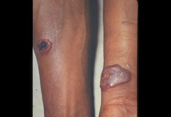 Fièvre charbonneuse (Anthrax): Humain, peau. Les lésions sont surélevées et ont des centres nécrotiques.