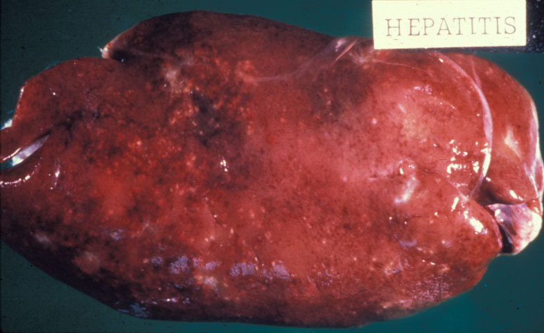 campylobacteriosis: Avian, liver. Swollen liver with rounded edges and multifocal white lesions due to Campylobacterosis.