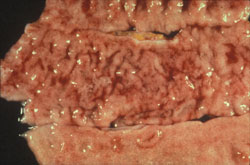 Campylobacteriosis: Primate, colon.  Mucosal edema, muco-hemorrhagic exudate, and thickened folds of the colon.   