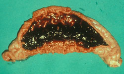 Campylobacteriosis: Pig, small intestine.  Hemorrhage in the lumen of the small intestine with thickened mucosal folds.   