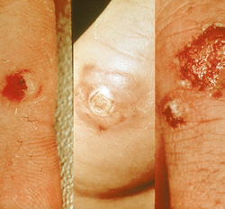 Contagious Ecthyma: Human, skin. Papules exhibit central necrosis and/or hemorrhage.