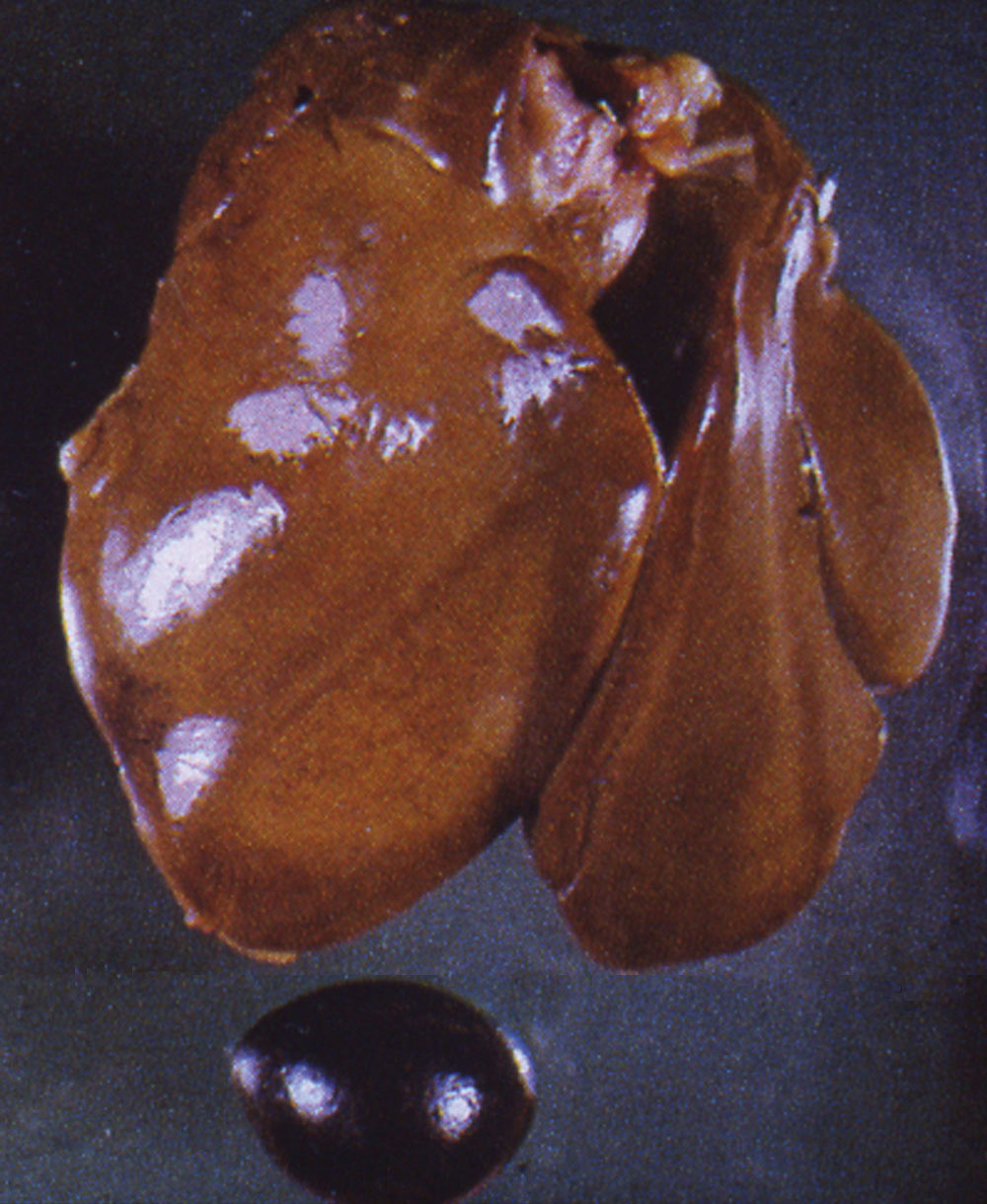 fowl-typhoid: Avian liver, spleen. Liver is pale with diffuse yellow-brown (bronze) discoloration; splenic congestion and enlargement.