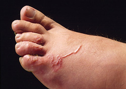 Larva Migrans: Human, foot. The foot is markedly edematous, and contains a raised, thin, red, serpiginous tract.