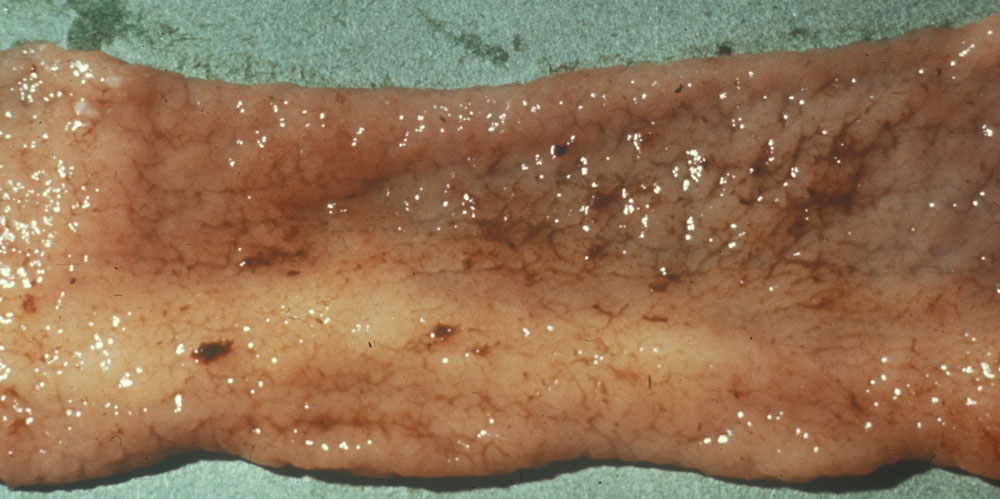paratuberculosis: Ovino, intestino. La superficie mucosa del intestino tiene una apariencia corrugada debida a un infiltrado granulomatoso. 