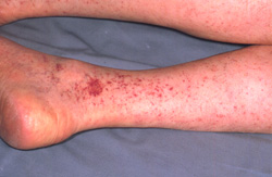 Rocky Mountain Spotted Fever: Human, legs. Disseminated cutaneous petechiae coalesce in two foci to form ecchymoses. 