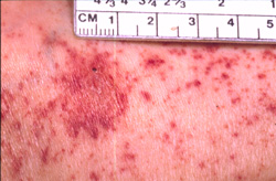 Rocky Mountain Spotted Fever: Human, skin. There are numerous, often coalescing petechiae. A single ecchymosis exhibits desquamation and contains a dark red focus (necrosis).