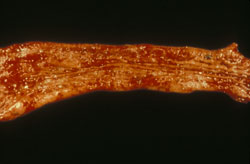 Salmonelosis: Cerdo, intestino. La luz intestinal presenta erosiones enrojecidas y un exudado fibrinonecrótico.