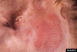 Sheep and Goat Pox: Sheep, inguinal skin. There are several coalescing macules.
