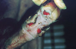 Enfermedad Vesicular Porcina: Suino, pata. Una pezuña y los dos dedos accesorios tienen úlceras en las bandas coronarias.