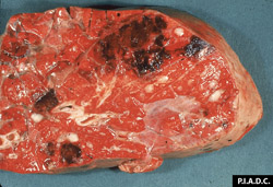 Teileriosis: Bovino, pulmón. El tejido pulmonar no está colapsado, contiene múltiples focos de hemorragia, y hay fluido / espuma dentro de los tabiques interlobulares y en el lumen de los bronquios.