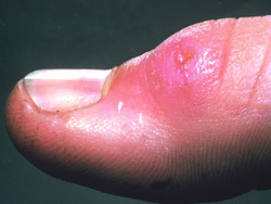 Tularemia: Human, skin. There is an ulcerated papule over the interphalangeal joint.