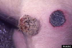 Peste porcine africaine: Porc, peau. Exsudat nécrotique qui se détache de la lésion à gauche. Sur la droite, on remarque un foyer hémorragique et nécrotique (infarctus) à bord hyperémique.