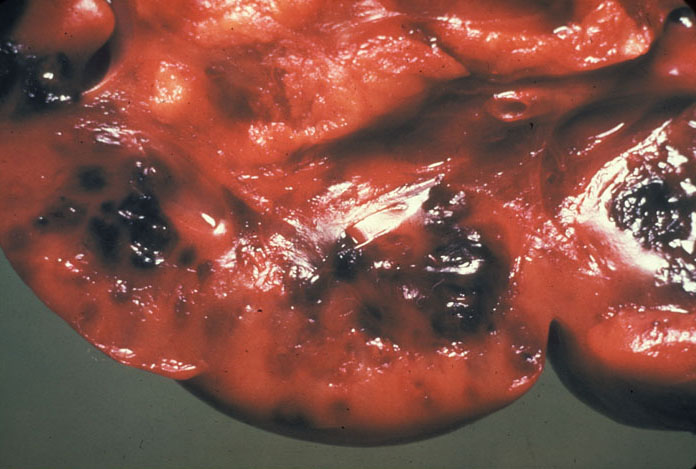 anthrax: Bovine, lymph node. The node is hyperemic and contains multiple dark foci of hemorrhage.