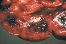 Anthrax: Bovine, lymph node. The node is hyperemic and contains multiple dark foci of hemorrhage.