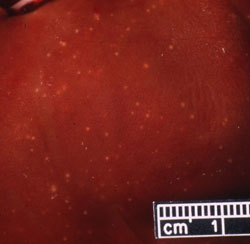 Aujeszky’s Disease: Liver. Diffuse multifocal white miliary lesions.