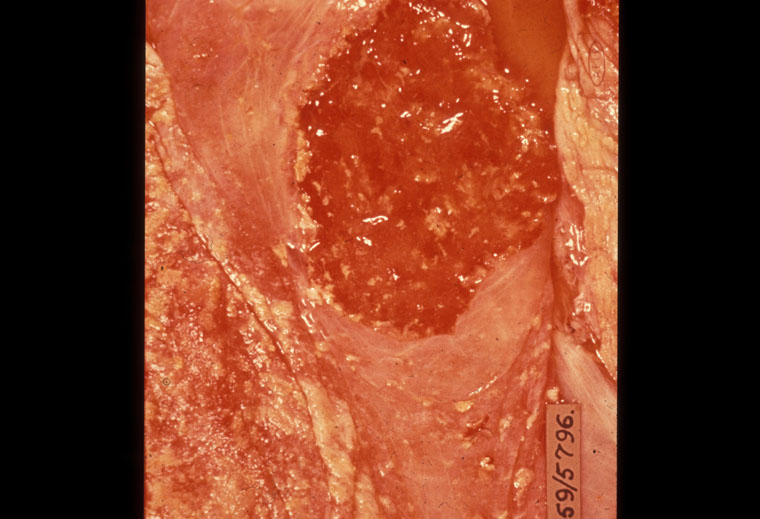 brucella-abortus: Bovine, placenta. Numerous pale clumps of exudate are scattered over the cotyledon and adjacent chorion.