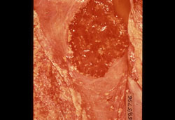 <i>Brucella abortus</i>: Bovin, placenta. De nombreux amas pâles d'exsudat sont dispersés sur le cotylédon et le chorion adjacent.