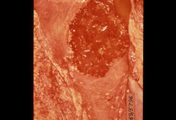 <i>Brucella abortus</i>: Bovine, placenta. Numerous pale clumps of exudate are scattered over the cotyledon and adjacent chorion.