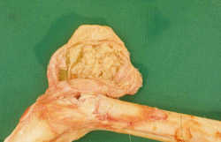 <i>Brucella abortus</i>: Caribou, carpus, B. suis biovar 4. The carpal bursa contains purulent exudate.