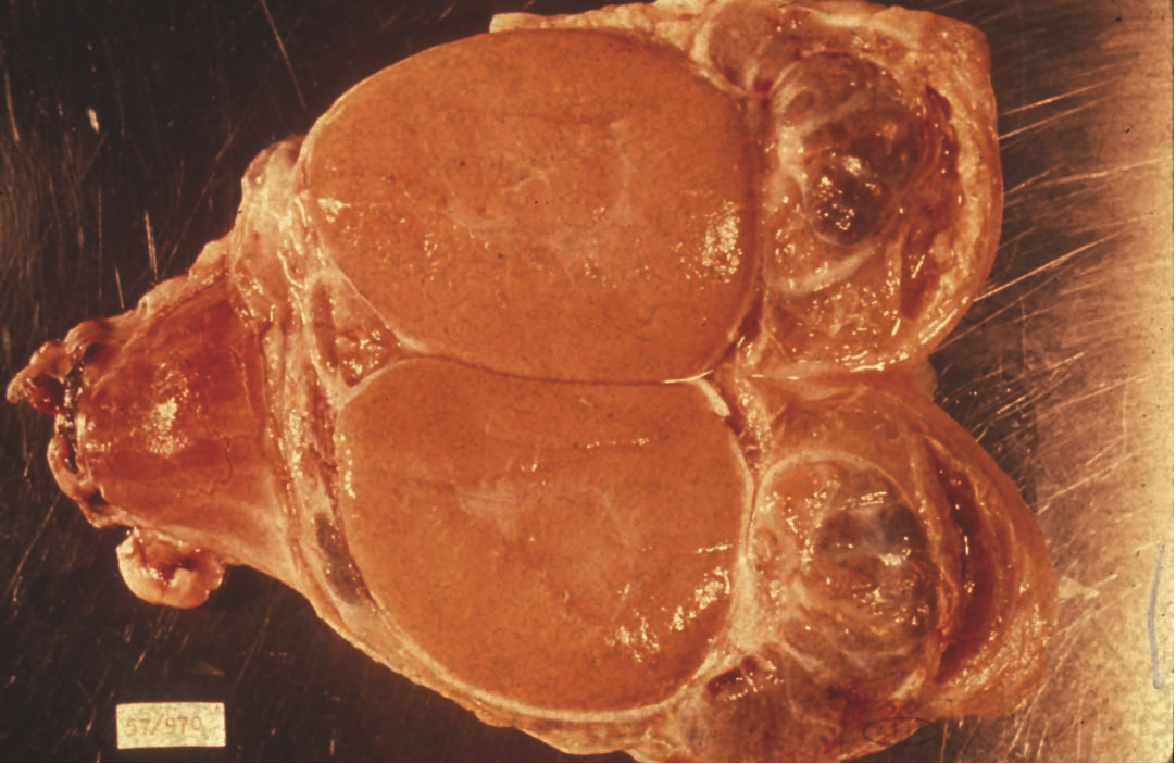 brucella-ovis: Carnero, testículo (seccionado). El epidídimo esta marcadamente agrandado y contiene bandas de tejido fibroso (epididimitis crónica). En este caso, el testículo esta relativamente sano.