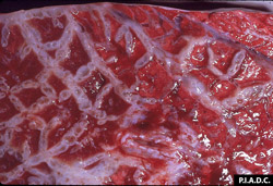 Pleuroneumonía Contagiosa Bovina: Bovino, pulmón. Los tabiques interlobulares están marcadamente engrosados por acumulación de tejido fibroso, y también contienen pequeñas depresiones (bolsas de aire=enfisema). Los lóbulos están enrojecidos y con exudado (congestión y edema).