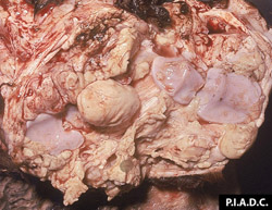 Pleuroneumonía Contagiosa Bovina: Bovino, carpo. Hay abundante fibrina dentro del espacio sinovial y en la sinovia y los cartílagos articulares contienen algunas erosiones pequeñas.