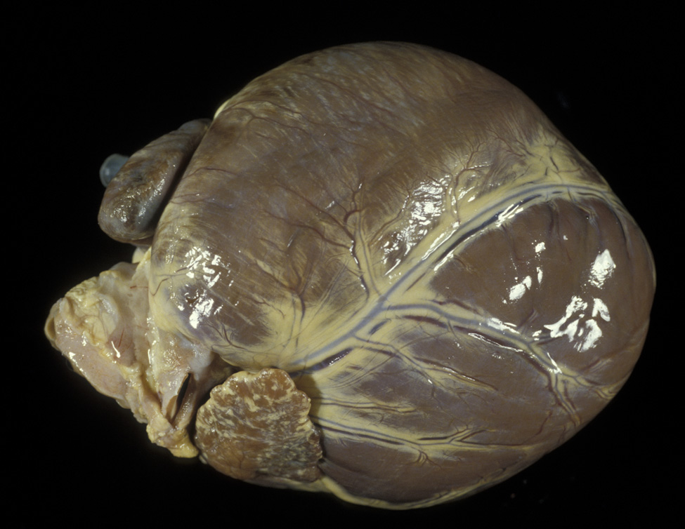 chagas: Dog, heart. There are multiple white linear streaks on the surface of the right and left ventricles corresponding to myocardial necrosis and myocarditis.