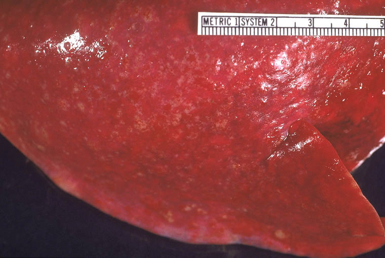 coccidioidomycosis: Marsupial, pulmón. El tejido del pulmón está colapsado y contiene numerosos nódulos pálidos firmes que se unen(granulomas).