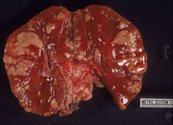 Coccidioidomicosis: Marsupial, riñon. Una sección del riñon muestra nódulos pálidos y elevados que se unen(granulomas).