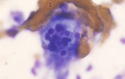 Coccidioidomycosis: A Coccidioides immitis spherule contains multiple endospores.