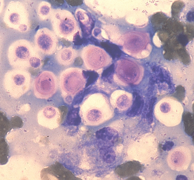 cryptococcosis: Gato. Este aspirado de una lesión cutánea contiene numerosas Cryptococcus neoformans  levaduras rodeadas de una cápsula que no se tiñe.Se puede observar gemación con base angosta. 