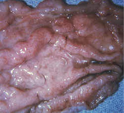 Cryptosporidiosis: Snake, stomach. The mucosal folds are markedly thickened, and there are numerous pinpoint foci of hyperemia. Hypertrophic gastritis due to Cryptosporidium sp.