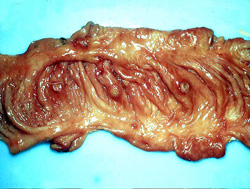 Classical Swine Fever: Porcine, colon. The mucosa is reddened and contains multiple discrete ("button") ulcers surrounded by zones of hemorrhage.
