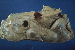 Echinococcosis: Zorrino (mofeta, mapurite), hígado. La superficie interna del quiste está delineada por arena   hidatídica y el quiste está rodeado por una capsula gruesa de tejido conectivo fibroso.