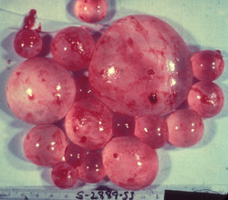 Echinococcosis: Humano, hígado. Múltiples quistes hidatídicos cubiertos por delgadas membranas se proyectan desde la superficie capsular hepática. 