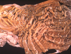 Enfermedad Hemorrágica Epizoótica: Ciervo, abomaso. Los pliegues de la mucosa están difusamente engrosados por edema y contienen areas de ulceraciones y hemorragias multifocales, claramente demarcadas de color rojo amarronado.