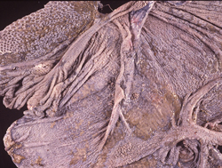 Enfermedad Hemorrágica Epizoótica: Ciervo, rumen y retículo(muestra conservada). La mucosa contiene numerosas areas de varios tamaños de ulceraciones y erosiones. 