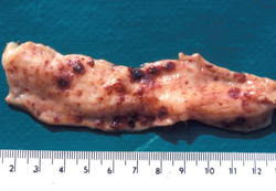 Ehrlichiosis: Dog, small intestine, Ehrlichia canis. There are multiple mucosal petechiae that coalesce to form larger, raised foci of hemorrhage. 