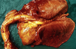 Equine Piroplasmosis: Horse, heart and lungs. The trachea and pericardial fat are icteric. Lungs are irregularly congested and there is consolidation of the right cranioventral lung.