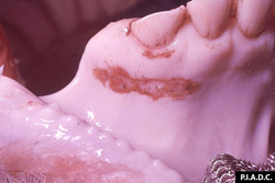 Foot and Mouth Disease: Bovine, gingiva. There is an elongate erosion (ruptured vesicle) ventral to the incisors.