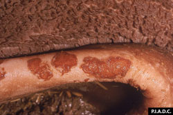 Fièvre aphteuse: Bovin, muqueuse du rumen, fort grossissement. Plusieurs érosions de forme irrégulière (vésicules rompues) sur le pilier.