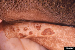 Foot and Mouth Disease: Rumen mucosa, higher magnification. There are
several irregularly shaped erosions (ruptured vesicles) on the pillar.