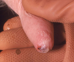 Foot and Mouth Disease: Teat. There is a ruptured vesicle on the end of the teat.