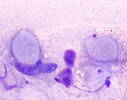 Giardiasis: Dog, duodenal cytology. Giardia lamblia trophozoites and dark staining free cell nuclei. 