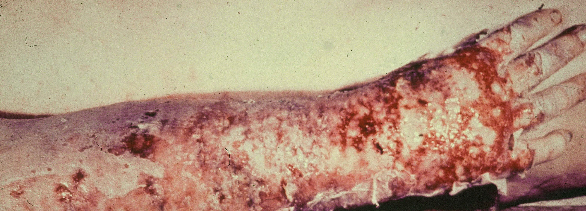 glanders: Human, skin. There is extensive ulceration and sloughing of the skin of the forearm and hand; the underlying tissues are edematous and hemorrhagic. Ulcers may be connected by lymphatic vessels (“Farcy pipes”) full of thick purulent exudate.