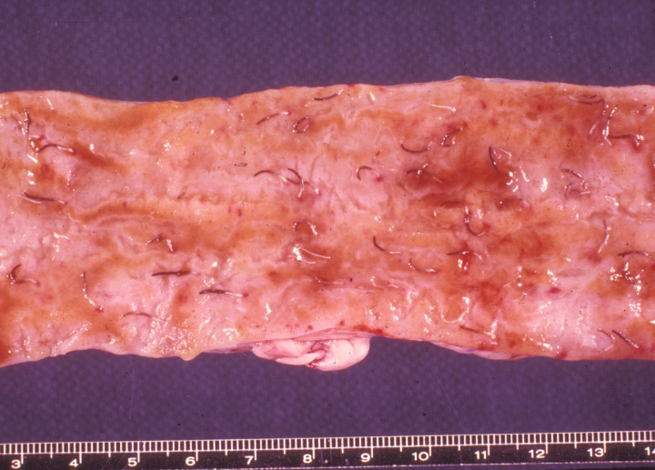 hookworms: Dog, small intestine, ancylostomiasis. The mucosal surface contains multiple foci of hemorrhage, and is covered by many hookworms, most of which contain injested blood.