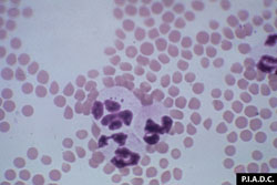 Heartwater: Goat, peripheral blood smear. A neutrophil contains a few Ehrlichia ruminantium.