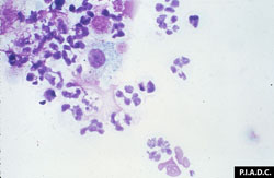 Cowdriosis: Caprino, frotis capa leucocitaria (leucocitos). Varios neutrófilos contienen mórulas de E. ruminantium