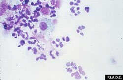 Heartwater: Goat, buffy coat smear. Several neutrophils contain E. ruminantium morulae.